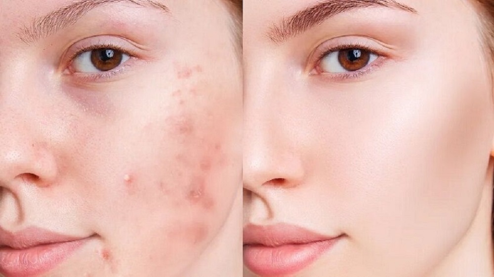 از بین بردن جوش صورت در یک روز