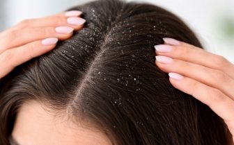 بهترین روش درمان شوره سر